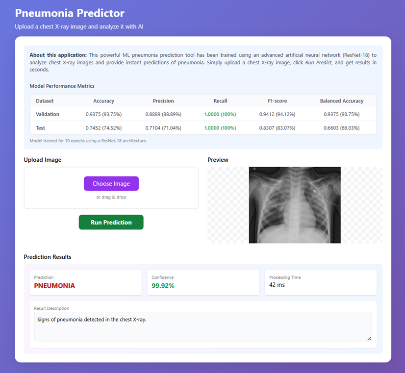 Pneumonia Detection